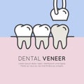 Dental Tooth Veneer Installation