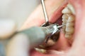 Dental treatment Royalty Free Stock Photo