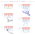 Dental treatment and care. Installation of veneers, stages of work. Instructions for dentists. Vector illustration for dentistry