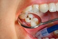 Dental treatment in dental clinic. Rotten carious tooth macro. T