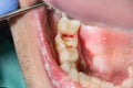 Dental treatment in dental clinic. Rotten carious tooth macro. T Royalty Free Stock Photo