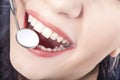 Dental Treatment with Mouth Mirror of Young Caucasian Female During Her Oral Examination. Royalty Free Stock Photo