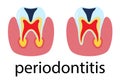 Dental treatment poster periodontitis. Human molar tooth