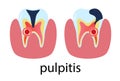 Dental treatment poster pulpitis. Human molar tooth