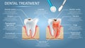 Dental treatment vector diagram education medical anatomy poster infographics