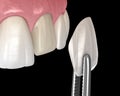 Dental Veneer installation procedure over central incisor. 3D illustration