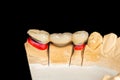 Dental veneers, ceramic and zirconium crowns of teeth close-up macro isolate on black background. Laboratory technical production Royalty Free Stock Photo