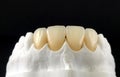 Dental veneers and crowns in the plaster model for treatment and new smile. Zirconia crowns with full porcelain. Dental Prosthetic Royalty Free Stock Photo