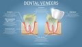 Dental veneers diagram, vector educational poster, diagram Royalty Free Stock Photo