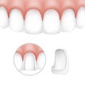 Dental veneers on human teeth Royalty Free Stock Photo