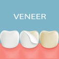 Dental veneers on a human tooth. Stock Royalty Free Stock Photo