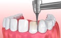 Dental Veneers: Porcelain Veneer installation Procedure. illustration Royalty Free Stock Photo