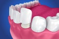 Dental Veneers: Porcelain Veneer installation Procedure.