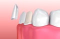 Dental Veneers: Porcelain Veneer installation Procedure Royalty Free Stock Photo