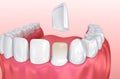 Dental Veneers: Porcelain Veneer installation Procedure Royalty Free Stock Photo