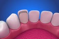 Dental Veneers: Porcelain Veneer installation Procedure. Royalty Free Stock Photo