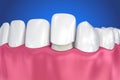 Dental Veneers: Porcelain Veneer installation Procedure. Royalty Free Stock Photo