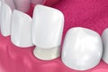 Dental Veneers: Porcelain Veneer installation Procedure