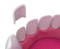 Dental Veneers: Porcelain Veneer installation Procedure.