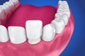 Dental Veneers: Porcelain Veneer installation Procedure.