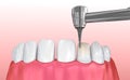 Dental Veneers: Porcelain Veneer installation Procedure. illustration Royalty Free Stock Photo