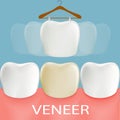 Dental veneers. Tooth anatomy.