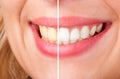 Dental Whitening Royalty Free Stock Photo