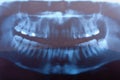Dental x-ray Royalty Free Stock Photo