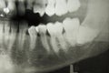 Dental X Ray Royalty Free Stock Photo