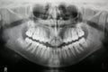 Dental X-ray Royalty Free Stock Photo