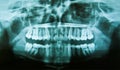 Dental X-Ray