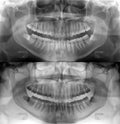 Dental x-ray Royalty Free Stock Photo