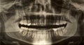 Dental x-ray Royalty Free Stock Photo