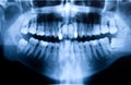 Dental X-ray Royalty Free Stock Photo