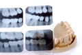 Dental X-Ray And Casting Royalty Free Stock Photo