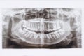 The Dental X-Ray ,x-ray film patient .Oral health. Black and white image