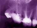 Dental x-ray film showing cured teeth