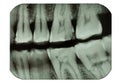 Dental x-ray film showing teeth Royalty Free Stock Photo