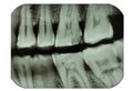 Dental x-ray film showing teeth