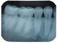 Dental x-ray film showing teeth