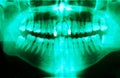 Dental X-ray on green tone Royalty Free Stock Photo