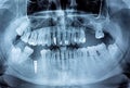 Dental x-ray with periodontitis problems, decayed teeth and implant