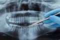 Dental X-ray. Radiography Royalty Free Stock Photo