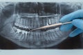 Dental X-ray. Radiography Royalty Free Stock Photo