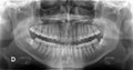 Dental x-ray Royalty Free Stock Photo