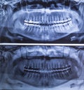 Dental X-ray of a woman`s teeth, panorama 180 degrees. X-ray with amalgan filling. Tooth filling Royalty Free Stock Photo