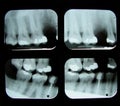 Dental x-rays Royalty Free Stock Photo