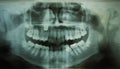 Dental Xray (x-ray) Royalty Free Stock Photo