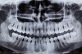 Dental Xray (x-ray)