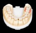 Dental zirconia bridge Royalty Free Stock Photo